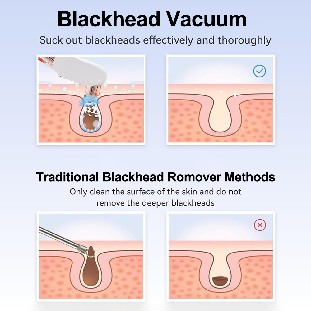 Removedor eléctrico de espinil - Pore Vacuum reseña y precio